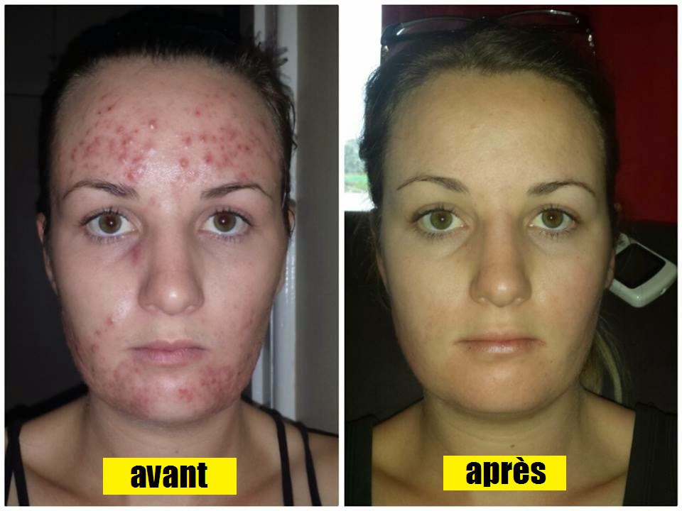 traitement acné | Instantly Ageless